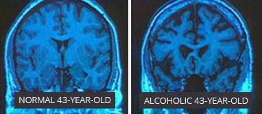 Scan of an alcoholic's brain versus a non-alcoholic's brain