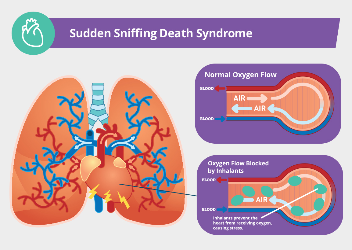 Sudden Sniffing Death Syndrome Infographic